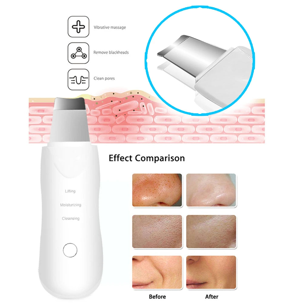 Vibration Face Skin Scrubber – Blackhead Remover & Deep Clean Tool